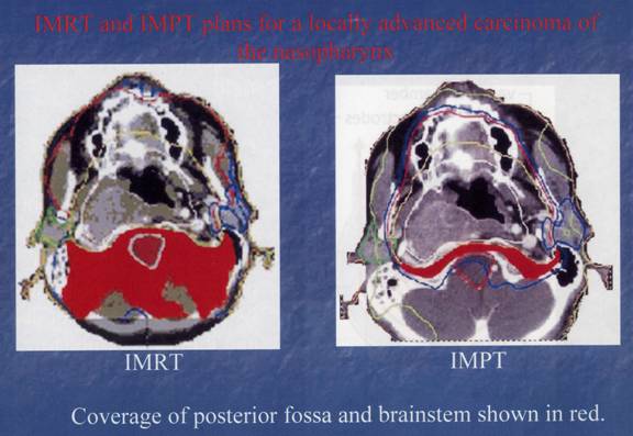 NASOPHARYNX